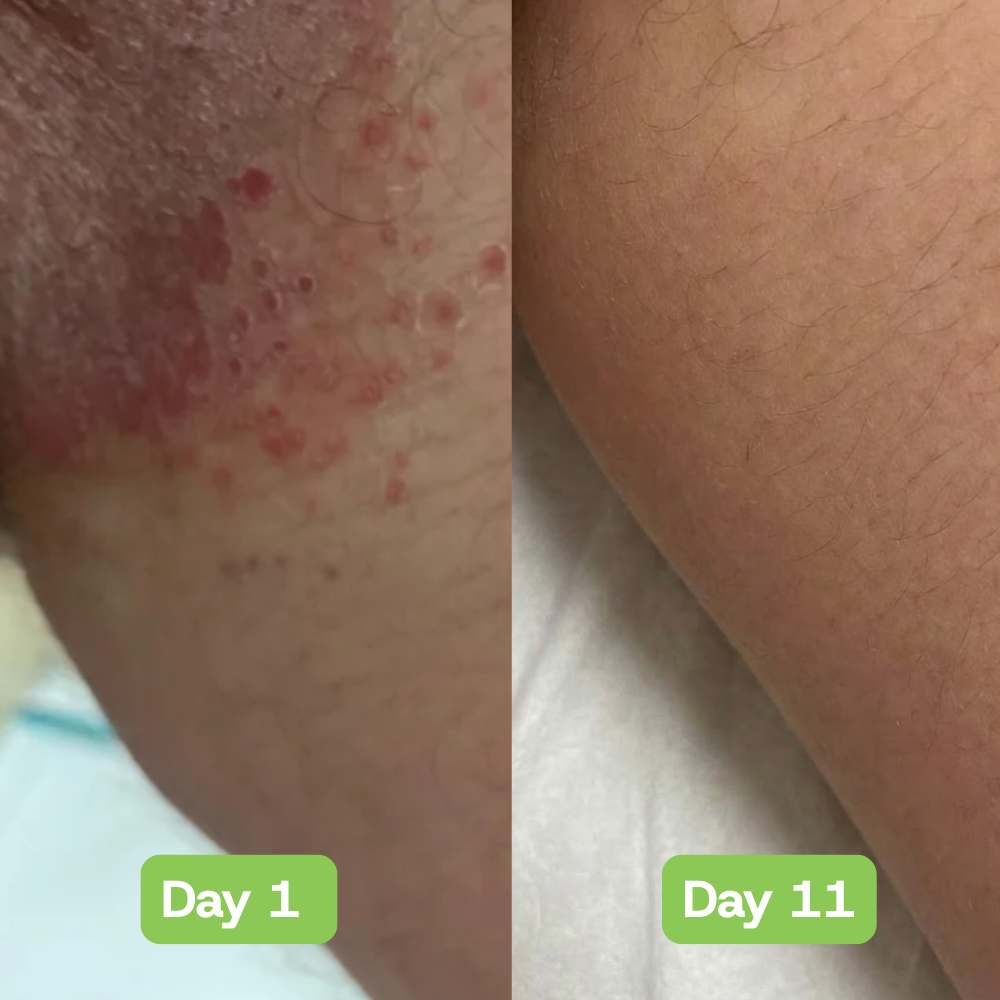 Veloria AntiFungal Relief