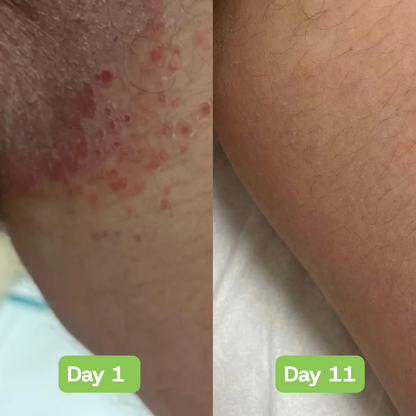 Veloria AntiFungal Relief