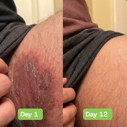 Veloria AntiFungal Relief